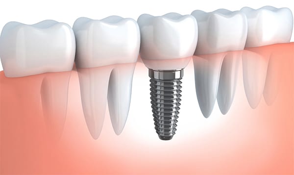 Dental Implant